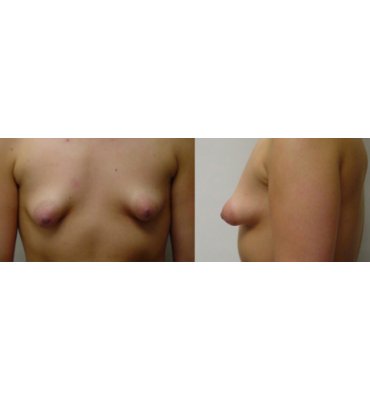 Tuberous Breast Deformity Before